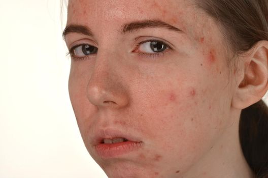 beautiful young girl with problematic skin, acne problem concept - image