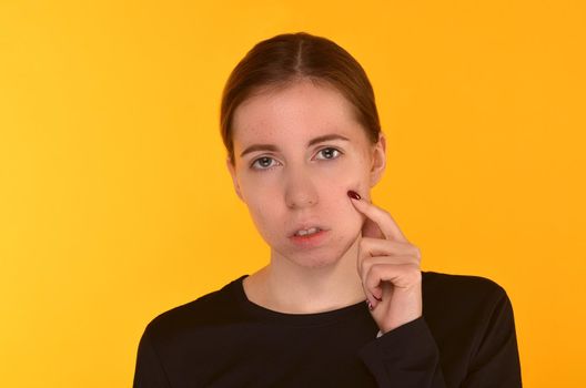 The appearance of acne due to malnutrition and stress - Image