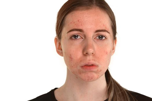 beautiful young girl with problematic skin, acne problem concept - image