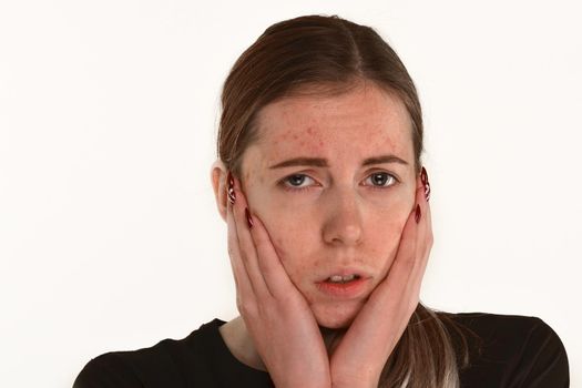 beautiful young girl with problematic skin, acne problem concept - image