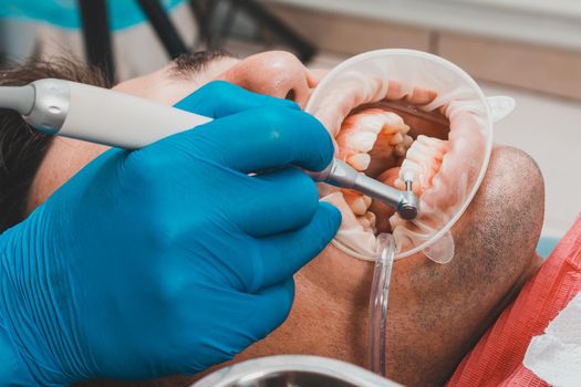 patient removing tartar,the dentist uses ultrasound to remove tartar,dental scaler.2020