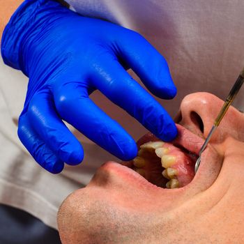 Visiting the dentist, the dentist evaluates the oral cavity and identifies problem areas of the teeth. Fistula mouth and gingivitis.