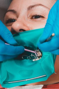 A patient at a dentist's appointment, a doctor uses a rubber dam to treat teeth, disinfects a tooth for filling.2020