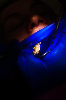 Close-up of the patient's mouth after filling the teeth with white composite resin on the insulation of a rubber dam, rubber dam and dental mirror. new