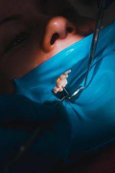 Close-up of the patient's mouth after filling the teeth with white composite resin on the insulation of a rubber dam, rubber dam and dental mirror. new