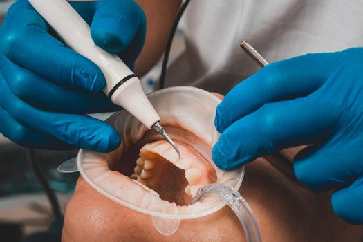 The dentist removes tartar using ultrasound, the patient at the dentist. Retractor for isolation of lips and gums. 2020