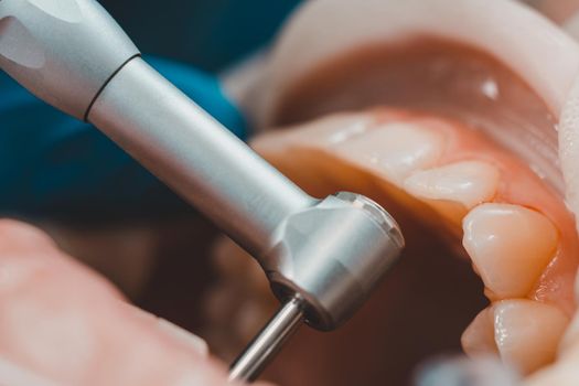 The dentist polishes the teeth with a drill, a dental procedure. Teeth polishing macro 2020
