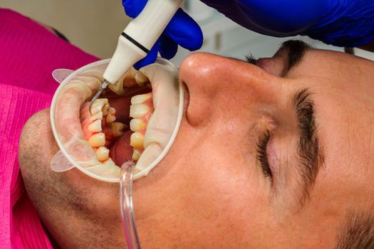 Dental practice, the dentist removes stones and hard plaque from the teeth with the help of ultrasound,patient with retractor and saliva ejector in the mouth.2020