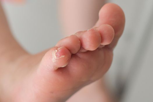 Enterovirus foot hand mouth disease Skin peeled off on the legs of a child Cocksackie virus