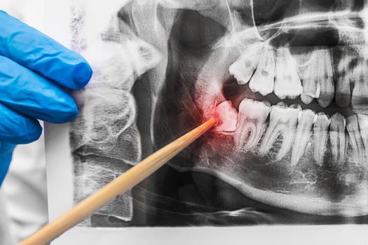 The dentist's hand in a medical rubber glove holds a x-ray image of the mouth and points to a well-made wisdom tooth, close-up.