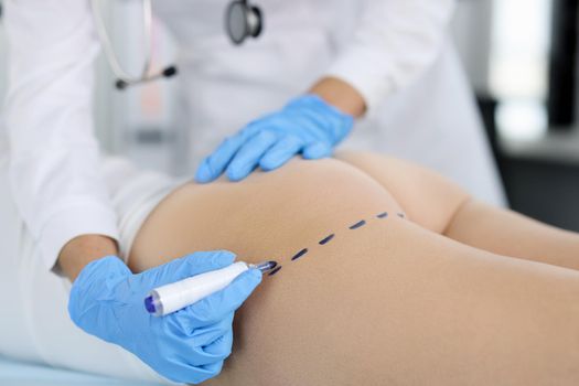 Doctor draws marks on the patient's buttocks with marker for body shaping. Buttocks plastic concept
