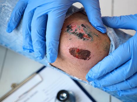 The doctor examines the healing wound of the patient on the leg of the knee torn jeans scarring