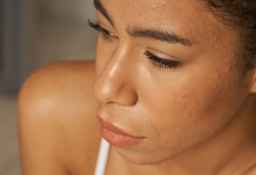 Close up portrait of young mixed race woman having acne, problematic skin. Beauty, skin treatment concept