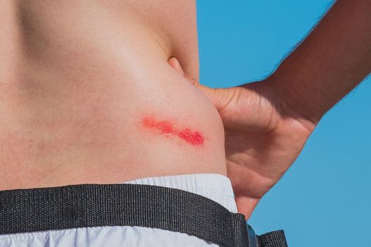 Man's hand on the belt next to a fresh wound abrasion injury with blood on his side, close-up.