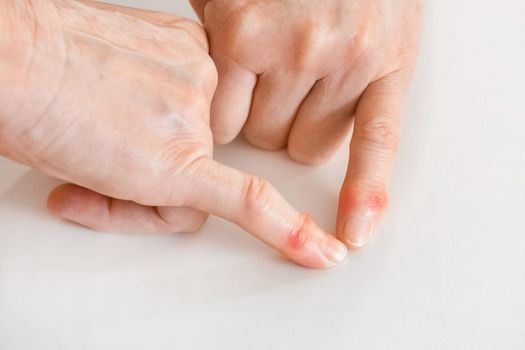Two hands of an elderly woman indicate a disease of fingers and a change in joints close-up.