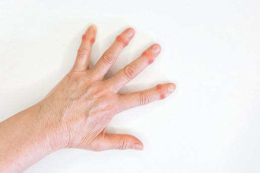 Hand of an old woman with sore fingers on a white background.