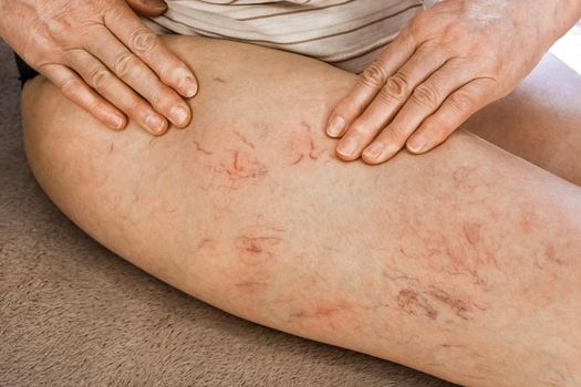 Hands of an elderly woman show on varicose veins, sick female legs, venous disease.