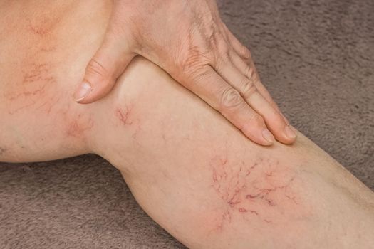 An elderly woman's hand touches her sick leg with vein thrombosis, varicose veins.