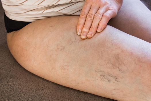 The hand of an elderly woman shows on varicose veins, sick female legs.