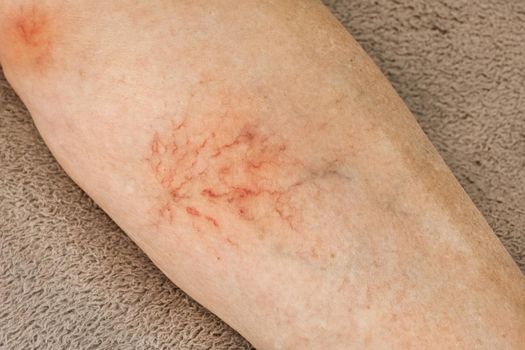 Varicose veins, sore female leg, venous disease.