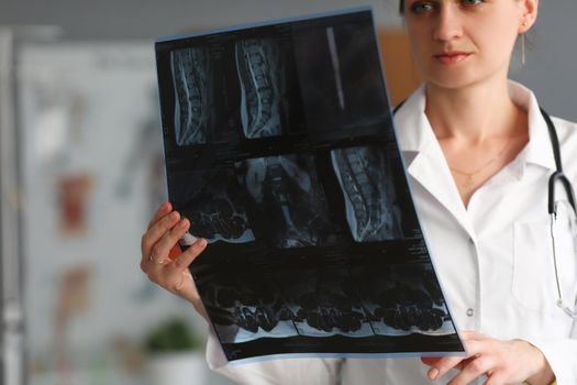 Young woman doctor is holding x-ray of person spine. Lumbar vertebrae displacement concept
