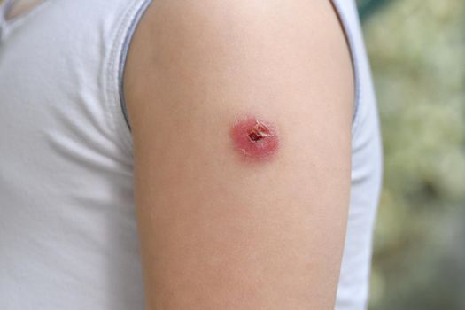 Hand of a child with a reaction to the BCG vaccine