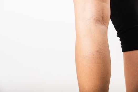 Closeup young Asian woman painful varicose and spider veins on leg, studio shot isolated on white background, Healthcare medical and hygiene skin body varicose veins problems care concept