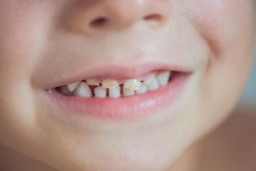 close up shot of baby teeth with caries.