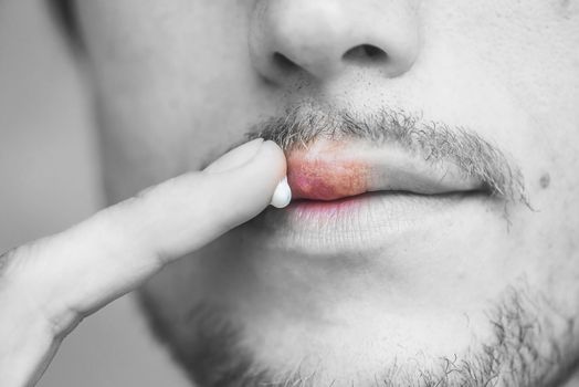 Herpes on lips of the young man. Man smears herpes with herpes cream. Black and white photo with color herpes