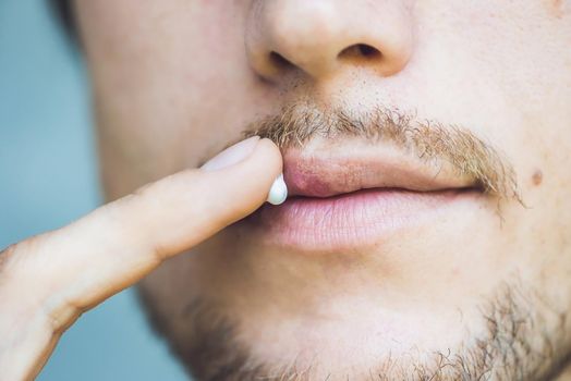 Herpes on lips of the young man. Man smears herpes with herpes cream.