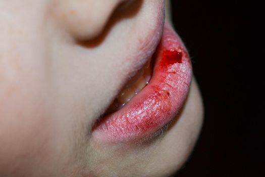 Dry and damaged lips of a girl. Close-up. Lip fissure and bleeding. Sick cracked damaged tissue. Dry lips with cracks, dry mouth, Closeup face with brittle and dry lips, dehydration High quality photo