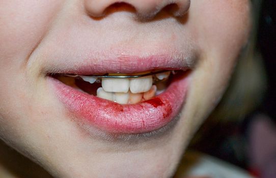 Dry and damaged lips of a girl. Close-up. Lip fissure and bleeding. Sick cracked damaged tissue. Dry lips with cracks, dry mouth, Closeup face with brittle and dry lips, dehydration High quality photo