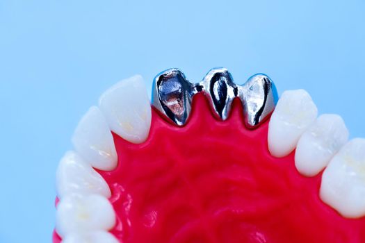 Teeth implant and crown installation process isolated on a blue background. Medically accurate 3D illustration