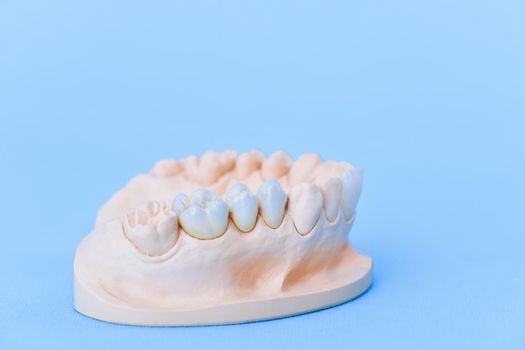 Gypsum model of human jaw with teeth on a blue background