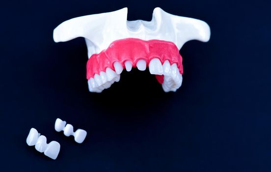 Teeth implant and crown installation process isolated on a blue background. Medically accurate 3D illustration