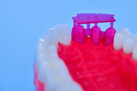 Teeth implant and crown installation process isolated on a blue background. Medically accurate 3D illustration