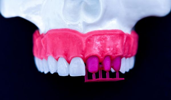 Teeth implant and crown installation process isolated on a blue background. Medically accurate 3D illustration