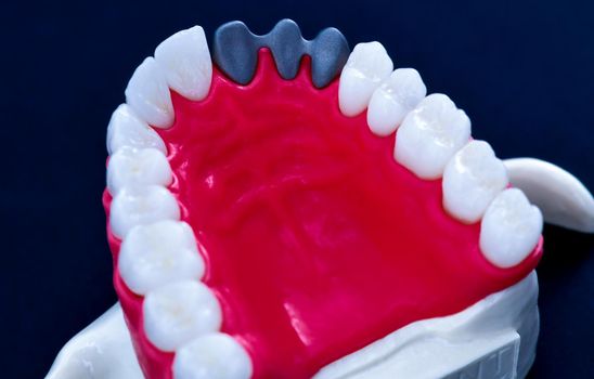 Teeth implant and crown installation process isolated on a blue background. Medically accurate 3D illustration