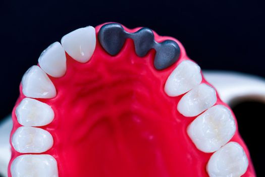 Teeth implant and crown installation process isolated on a blue background. Medically accurate 3D illustration