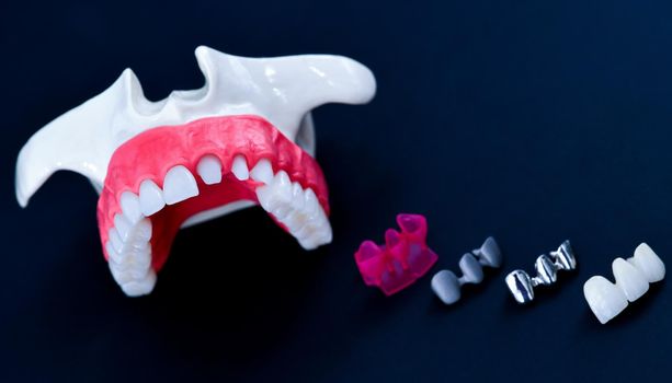 Teeth implant and crown installation process isolated on a blue background. Medically accurate 3D illustration