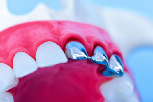 Teeth implant and crown installation process isolated on a blue background. Medically accurate 3D illustration