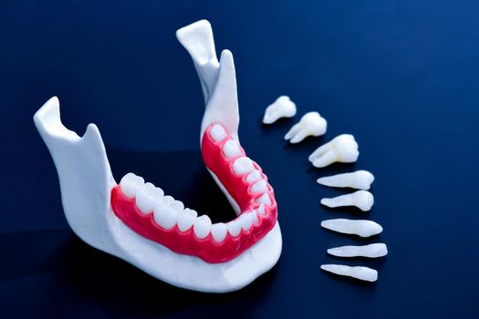 Teeth implant and crown installation process isolated on a blue background. Medically accurate 3D illustration