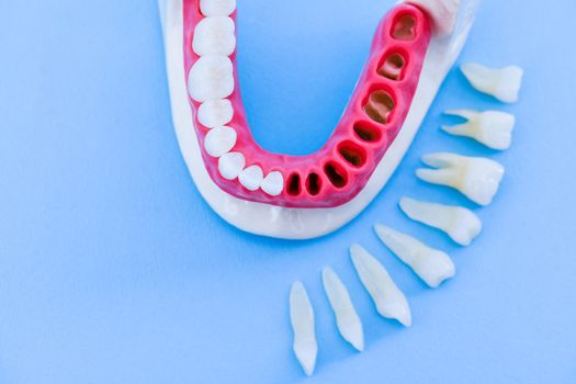 Teeth implant and crown installation process isolated on a blue background. Medically accurate 3D illustration