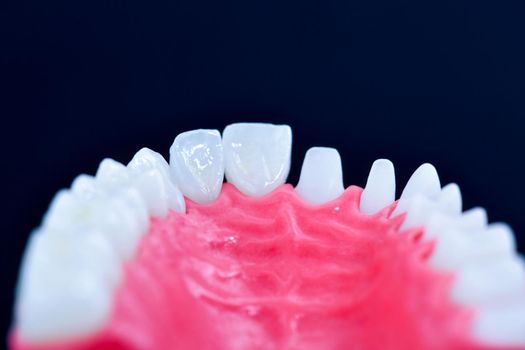 Teeth implant and crown installation process isolated on a blue background. Medically accurate 3D illustration