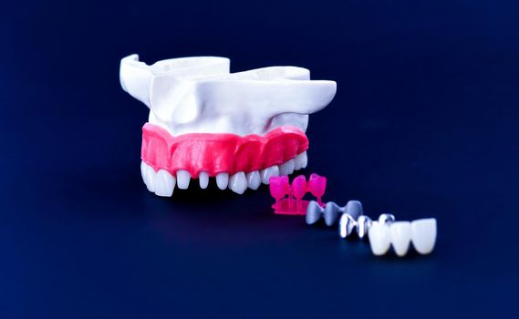 Teeth implant and crown installation process isolated on a blue background. Medically accurate 3D illustration