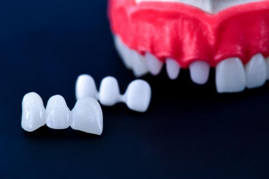 Teeth implant and crown installation process isolated on a blue background. Medically accurate 3D illustration