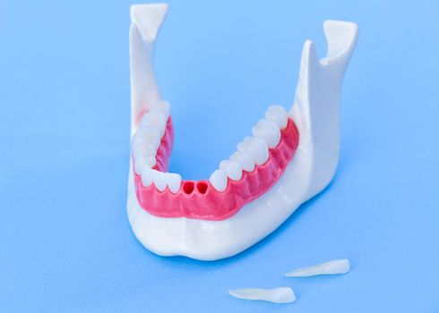 Teeth implant and crown installation process isolated on a blue background. Medically accurate 3D illustration