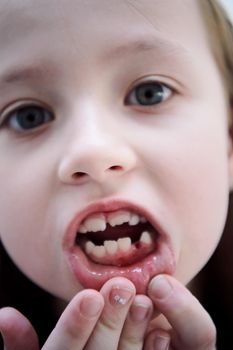 Funny little girl without tooth smiles showing gap close up