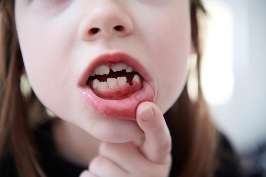 Funny little girl without tooth smiles showing gap close up