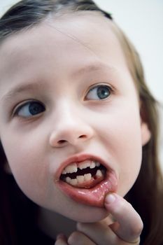 Funny little girl without tooth smiles showing gap close up